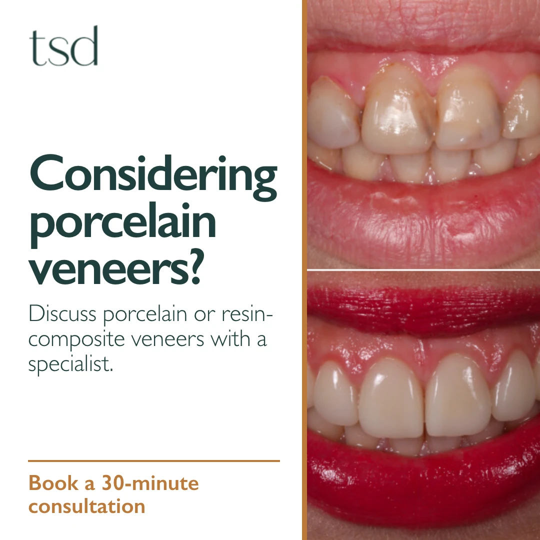 Porcelain veneers ad creative
